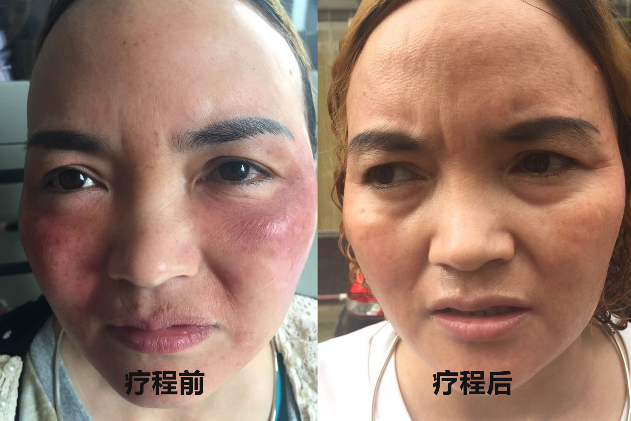 激素脸